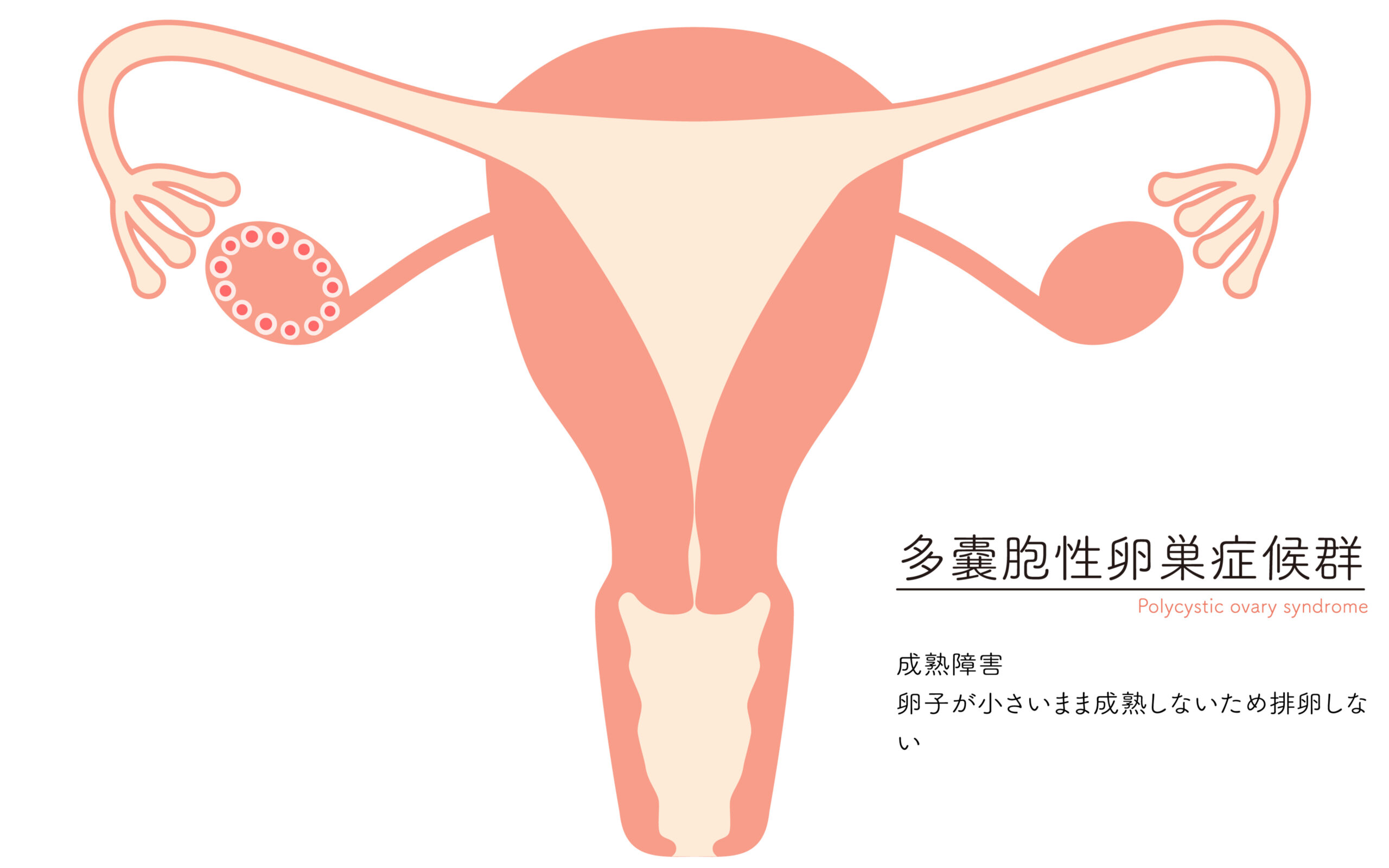 多嚢胞性卵巣症候群